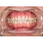 Ultradent - λευκανση - δοντια - KleerView Ενηλίκων KleerView - Παρειοκάτοχο 